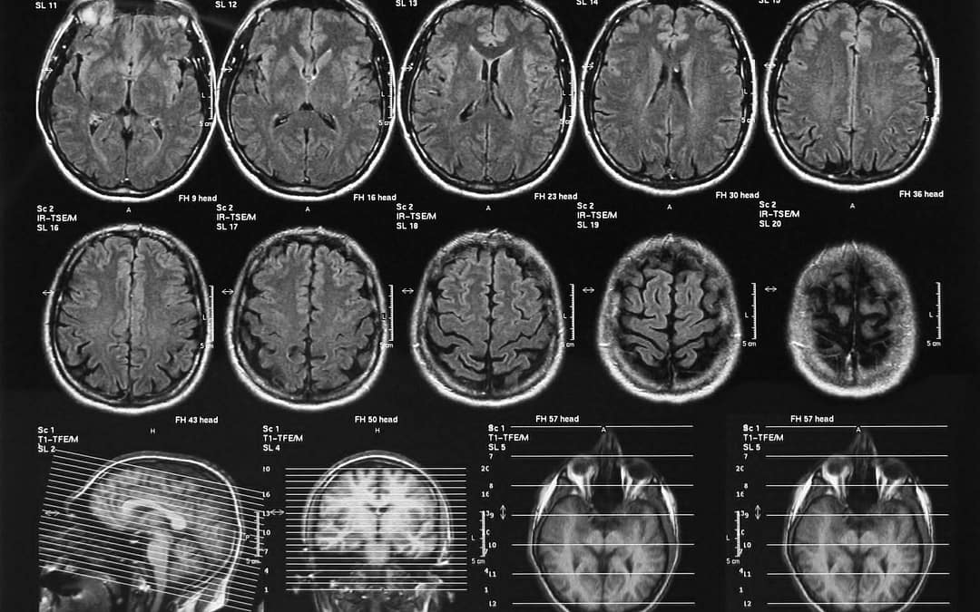 Understanding the complications of traumatic brain injuries