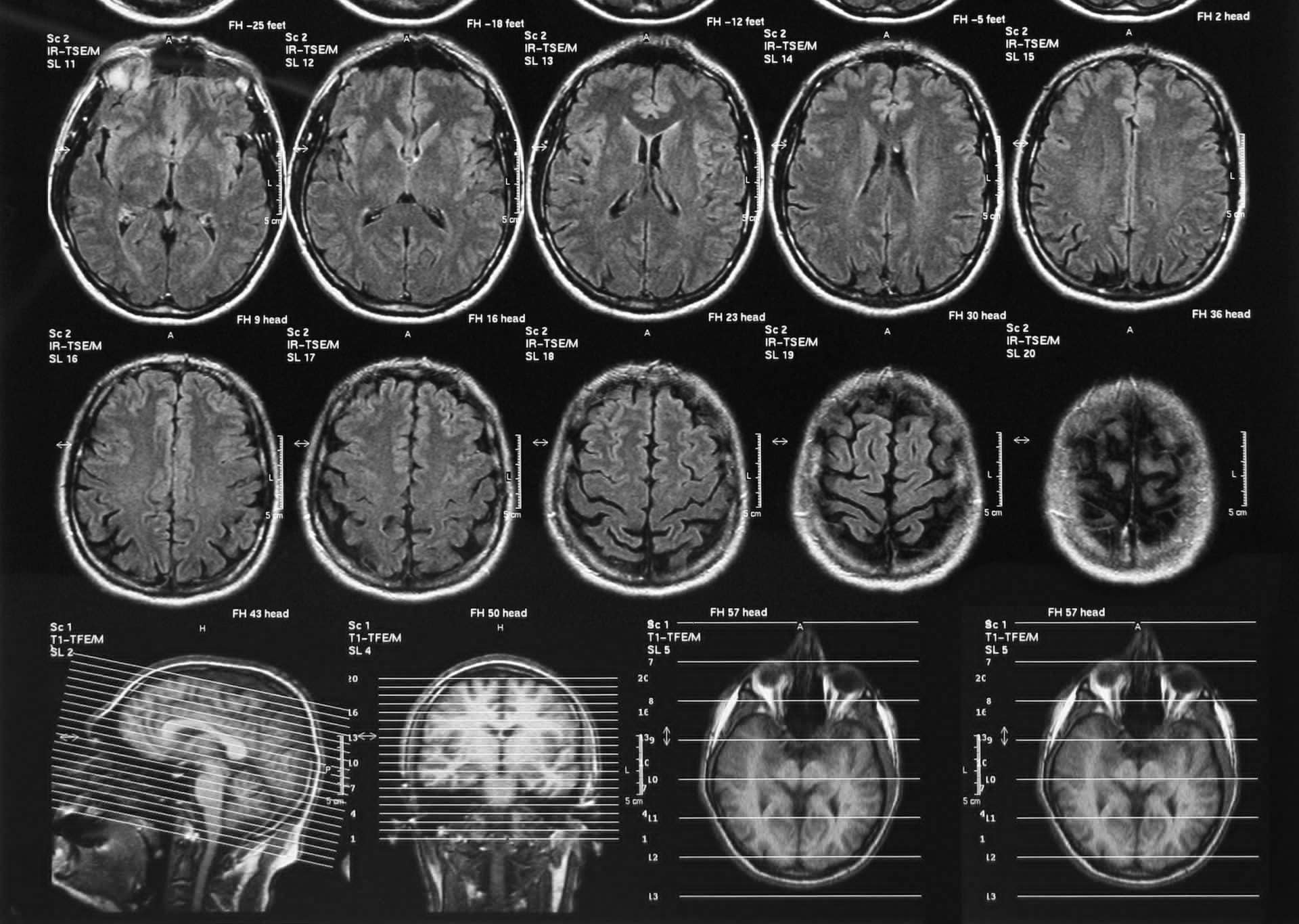 brain injury x-ray